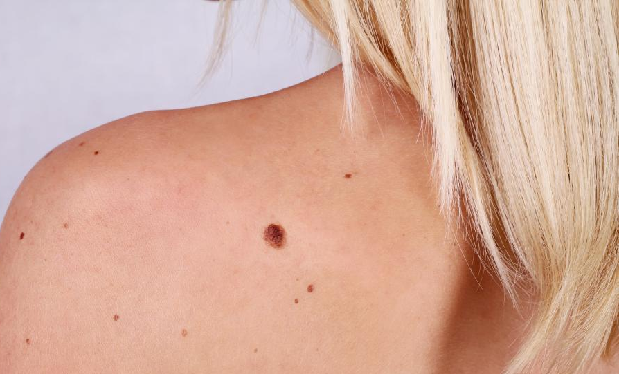 How To Use Castor Oil To Remove Moles
