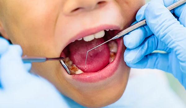 7 ways to get rid of Cavities