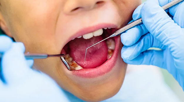 7 ways to get rid of Cavities