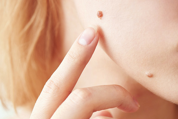 How To Use Tea Tree Oil to Remove Skin Tags