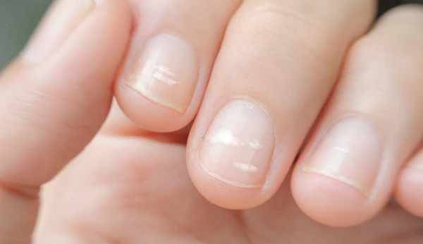 White Spots On Fingernails – Causes And Treatment